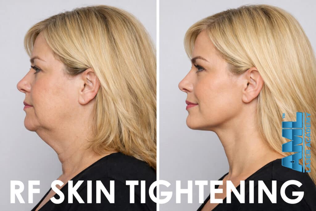 Before and after comparison showing reduced under-chin laxity and improved jawline definition